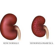 Scopri di più sull'articolo Nefropatia diabetica