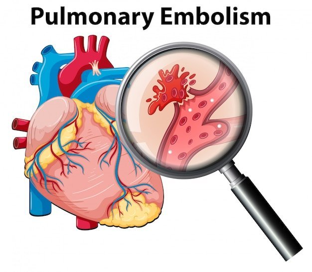 Scopri di più sull'articolo Embolia polmonare