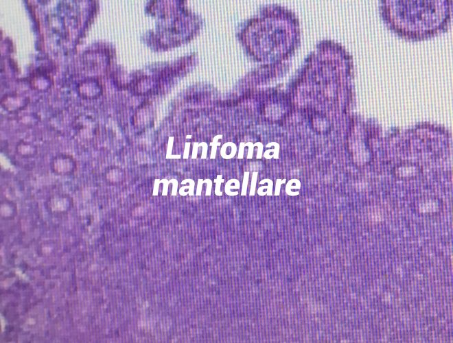 Linfoma mantellare