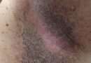 L'acanthosis nigricans è una dermatosi. Una dermatosi è una malattia della pelle. L'acanthosis nigricans è caratterizzata da un ispessimento e un inscurimento della pelle, specialmente nelle pieghe del corpo