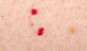 L'angioma cutaneo è una neoformazione benigna della pelle, causata da un anomalo sviluppo cellulare dei vasi sanguigni o linfatici.