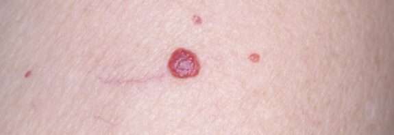 L'angioma rubino è un tumore benigno della pelle che si presenta come una piccola chiazza o papula di colore rosso vivo. È causato da un'anomalia dei vasi sanguigni, che si dilatano e si riempiono di sangue.