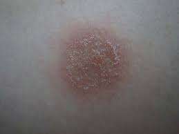 L'eczema nummulare è una forma di dermatite caratterizzata dalla comparsa di piccole macchie rotonde o ovali sulla pelle, spesso accompagnate da prurito intenso.