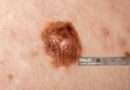 Il melanoma è un tipo di cancro della pelle che si sviluppa a partire dalle cellule chiamate melanociti, che producono il pigmento melanina responsabile del colore della pelle, dei capelli e degli occhi. I fattori di rischio per lo sviluppo del melanoma includono l'esposizione eccessiva alla luce solare o alle lampade abbronzanti, la presenza di nei atipici o displastici, la storia familiare di melanoma, la pelle chiara, i capelli biondi o rossi e gli occhi chiari.