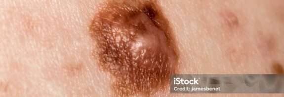 Il melanoma è un tipo di cancro della pelle che si sviluppa a partire dalle cellule chiamate melanociti, che producono il pigmento melanina responsabile del colore della pelle, dei capelli e degli occhi. I fattori di rischio per lo sviluppo del melanoma includono l'esposizione eccessiva alla luce solare o alle lampade abbronzanti, la presenza di nei atipici o displastici, la storia familiare di melanoma, la pelle chiara, i capelli biondi o rossi e gli occhi chiari.