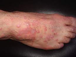 Il lichen planus è una malattia infiammatoria cronica della pelle e delle mucose, caratterizzata dalla comparsa di piccole lesioni o papule pruriginose, violacee o biancastre, generalmente piatte e con una forma angolare. Può interessare diverse parti del corpo, come la pelle, la bocca, le unghie, i genitali, il cuoio capelluto e le mucose.