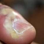 Il patereccio è un'infezione dolorosa che colpisce la punta delle dita delle mani o dei piedi . È causata da batteri, in genere stafilococchi o streptococchi, che penetrano attraverso piccole ferite o tagli