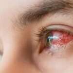 Lesioni oculari