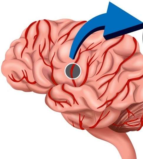 Scopri di più sull'articolo Lesione cerebrale