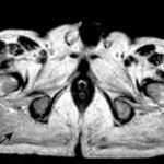 Distrofia Muscolare Oculofaringea