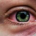 Allergie oculari