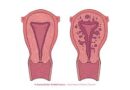 L'adenomiosi è una condizione ginecologica che si verifica quando il tessuto che normalmente riveste l'interno dell'utero (endometrio) cresce e penetra nella parete muscolare dell'utero stesso (miometrio).