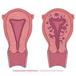 L'adenomiosi è una condizione ginecologica che si verifica quando il tessuto che normalmente riveste l'interno dell'utero (endometrio) cresce e penetra nella parete muscolare dell'utero stesso (miometrio).