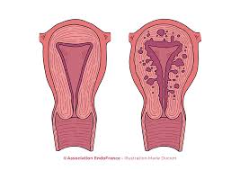 L'adenomiosi è una condizione ginecologica che si verifica quando il tessuto che normalmente riveste l'interno dell'utero (endometrio) cresce e penetra nella parete muscolare dell'utero stesso (miometrio).