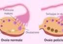 La Sindrome dell'Ovaio Policistico (PCOS) è una condizione endocrina piuttosto comune nelle donne in età fertile, caratterizzata da uno squilibrio ormonale che può influenzare diversi aspetti della salute, compresa la fertilità.