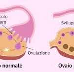 La Sindrome dell'Ovaio Policistico (PCOS) è una condizione endocrina piuttosto comune nelle donne in età fertile, caratterizzata da uno squilibrio ormonale che può influenzare diversi aspetti della salute, compresa la fertilità.