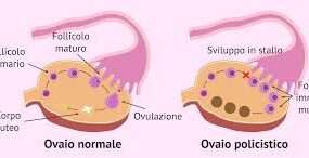 La Sindrome dell'Ovaio Policistico (PCOS) è una condizione endocrina piuttosto comune nelle donne in età fertile, caratterizzata da uno squilibrio ormonale che può influenzare diversi aspetti della salute, compresa la fertilità.