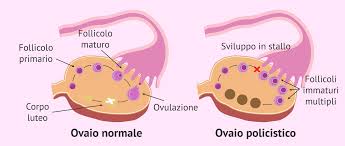 La Sindrome dell'Ovaio Policistico (PCOS) è una condizione endocrina piuttosto comune nelle donne in età fertile, caratterizzata da uno squilibrio ormonale che può influenzare diversi aspetti della salute, compresa la fertilità.