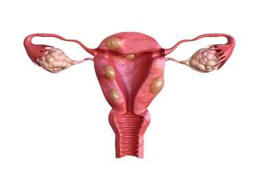 Come abbiamo già visto, i fibromi uterini sono tumori benigni che si sviluppano nel muscolo dell'utero.