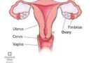 Il cancro dell'ovaio è una malattia che si sviluppa nelle ovaie, due piccoli organi a forma di mandorla situati ai lati dell'utero. Queste ghiandole producono gli ormoni sessuali femminili (estrogeni e progesterone) e le cellule uovo. Quando le cellule dell'ovaio si moltiplicano in modo incontrollato e anomalo, si forma un tumore.