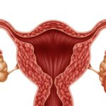 Le cisti ovariche sono sacche piene di liquido che si formano all'interno o sulla superficie di un ovaio. Gli ovai sono due organi riproduttivi femminili situati su entrambi i lati dell'utero. Le cisti ovariche sono molto comuni e la maggior parte non causa alcun sintomo.