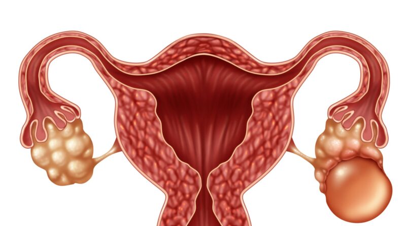 Le cisti ovariche sono sacche piene di liquido che si formano all'interno o sulla superficie di un ovaio. Gli ovai sono due organi riproduttivi femminili situati su entrambi i lati dell'utero. Le cisti ovariche sono molto comuni e la maggior parte non causa alcun sintomo.