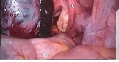 L'endometrioma, anche conosciuto come cisti endometriosica o "cisti cioccolato", è una formazione cistica che si sviluppa all'interno delle ovaie. Si tratta di una manifestazione dell'endometriosi,