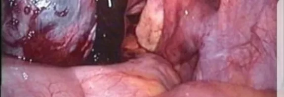 L'endometrioma, anche conosciuto come cisti endometriosica o "cisti cioccolato", è una formazione cistica che si sviluppa all'interno delle ovaie. Si tratta di una manifestazione dell'endometriosi,