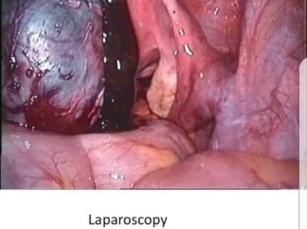 L'endometrioma, anche conosciuto come cisti endometriosica o "cisti cioccolato", è una formazione cistica che si sviluppa all'interno delle ovaie. Si tratta di una manifestazione dell'endometriosi,