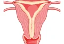 L'iperplasia endometriale è una condizione caratterizzata da un'eccessiva crescita delle cellule che rivestono l'endometrio, il tessuto che riveste l'utero.