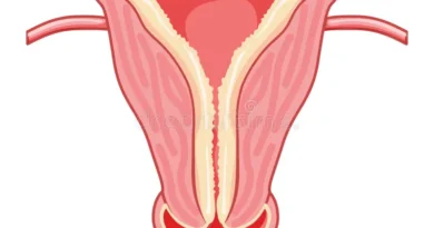 L'iperplasia endometriale è una condizione caratterizzata da un'eccessiva crescita delle cellule che rivestono l'endometrio, il tessuto che riveste l'utero.