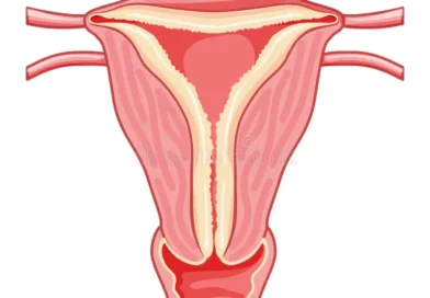 L'iperplasia endometriale è una condizione caratterizzata da un'eccessiva crescita delle cellule che rivestono l'endometrio, il tessuto che riveste l'utero.