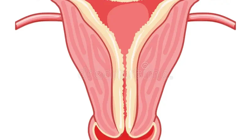 L'iperplasia endometriale è una condizione caratterizzata da un'eccessiva crescita delle cellule che rivestono l'endometrio, il tessuto che riveste l'utero.