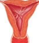 La Sindrome di Asherman (SA) è una condizione rara, ma significativa, che colpisce l'apparato riproduttivo femminile. È caratterizzata dalla formazione di aderenze e tessuto cicatriziale all'interno della cavità uterina e/o della cervice, che possono ostruire parzialmente o completamente l'utero.