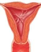 La Sindrome di Asherman (SA) è una condizione rara, ma significativa, che colpisce l'apparato riproduttivo femminile. È caratterizzata dalla formazione di aderenze e tessuto cicatriziale all'interno della cavità uterina e/o della cervice, che possono ostruire parzialmente o completamente l'utero.